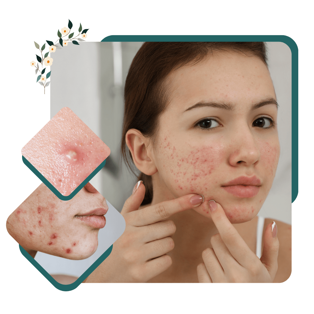 Acne / Pimple